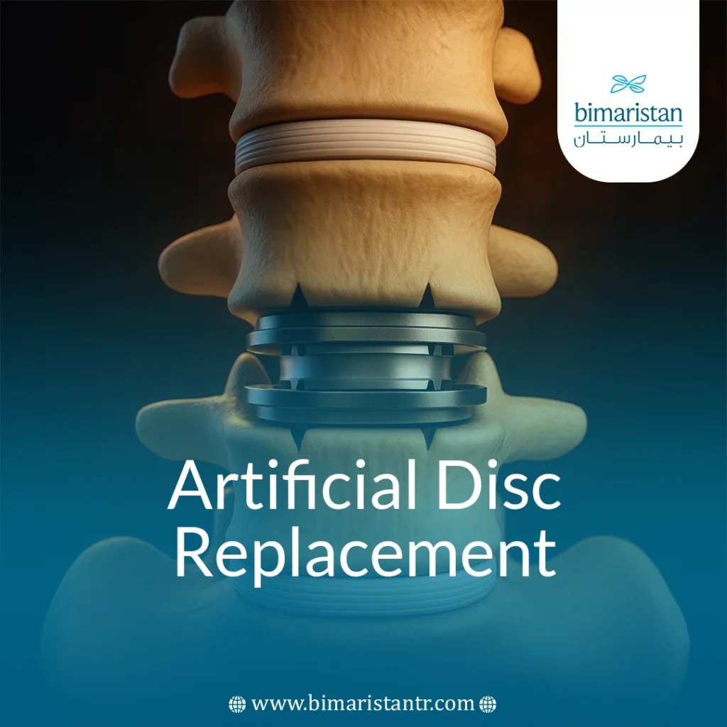 Artificial Disc Replacement: A Modern Alternative To Spinal Fusion For Herniated Discs