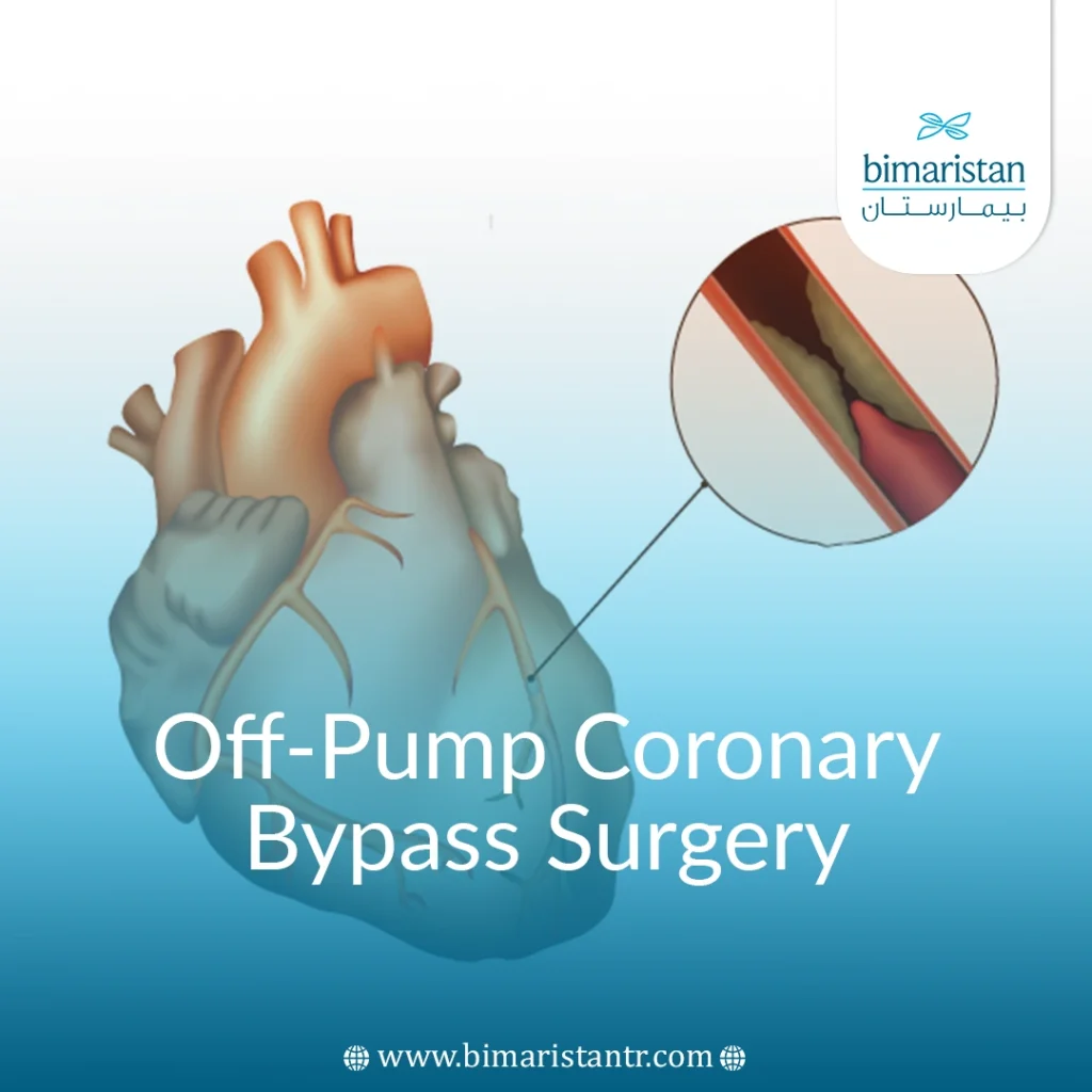 Off-Pump Coronary Bypass Surgery In Turkey: Benefits Guide