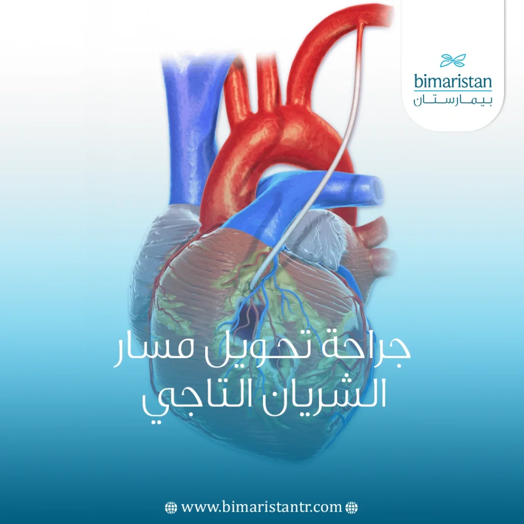 جراحة تحويل مسار الشريان التاجي في تركيا
