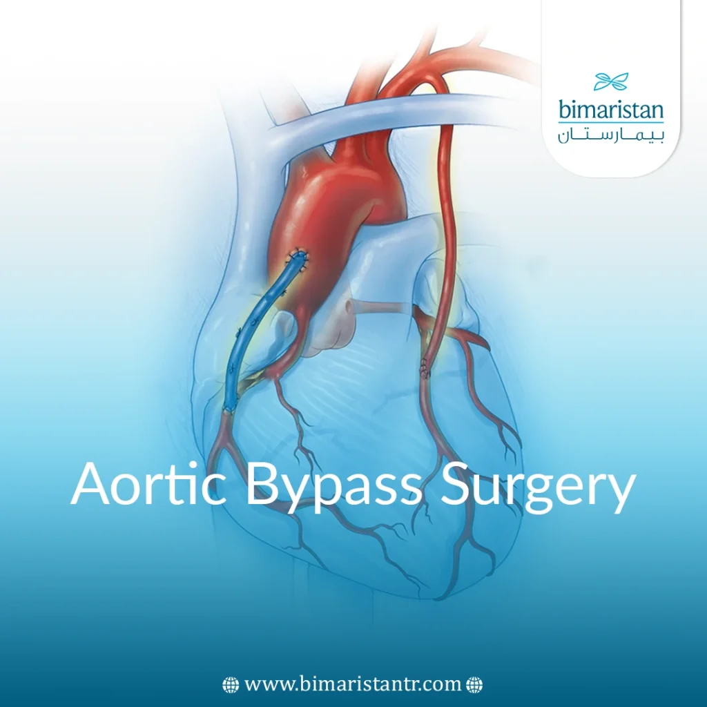Aortic Bypass Surgery: A Complete Guide In Turkey