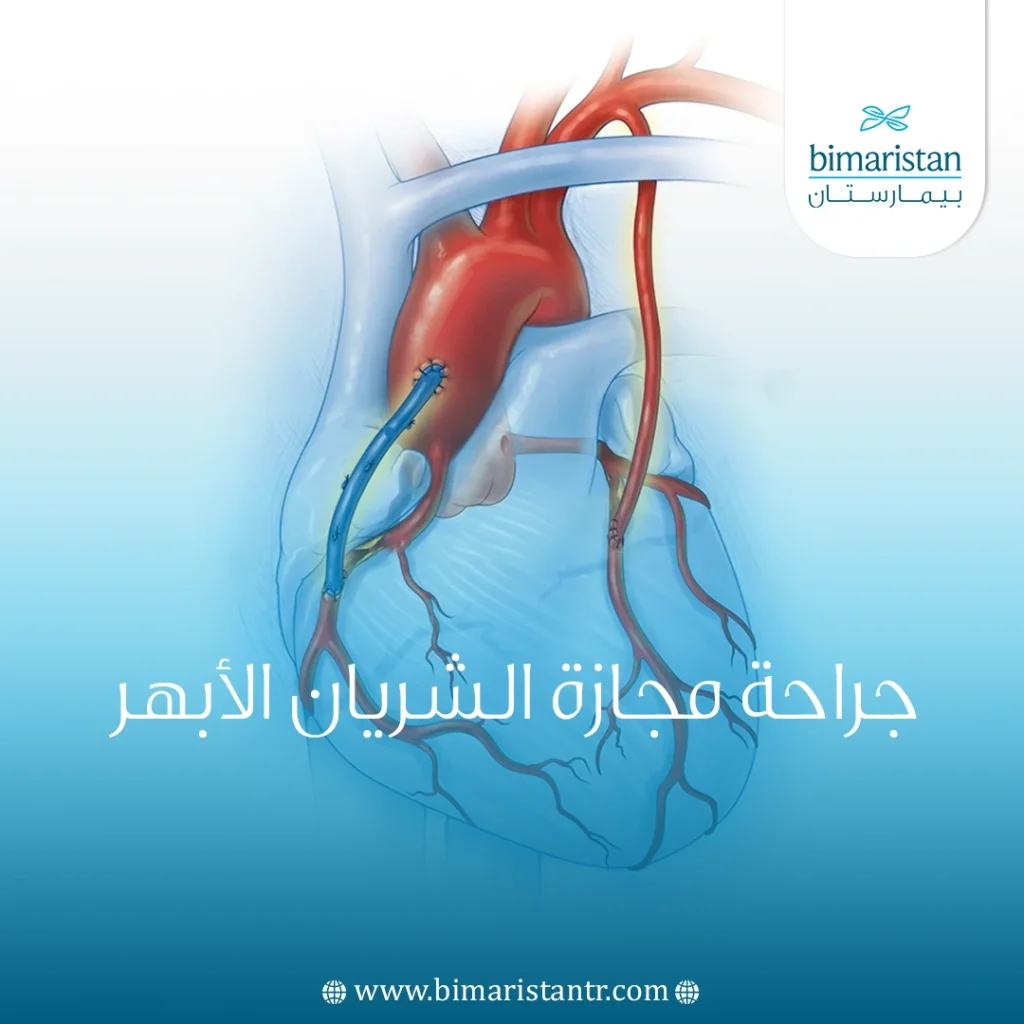 جراحة مجازة الشريان الأبهر في تركيا - بيمارستان