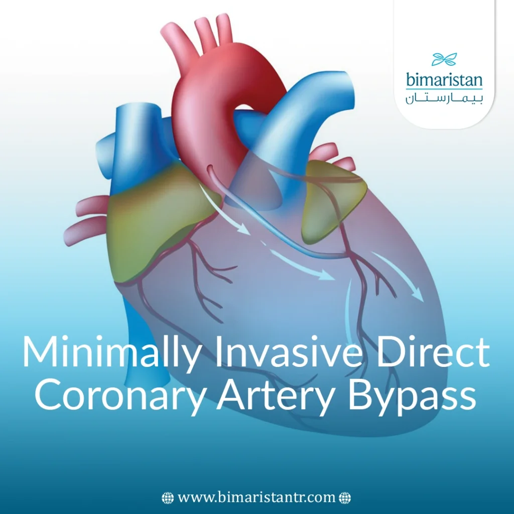 Minimally Invasive Direct Coronary Artery Bypass (Midcab)