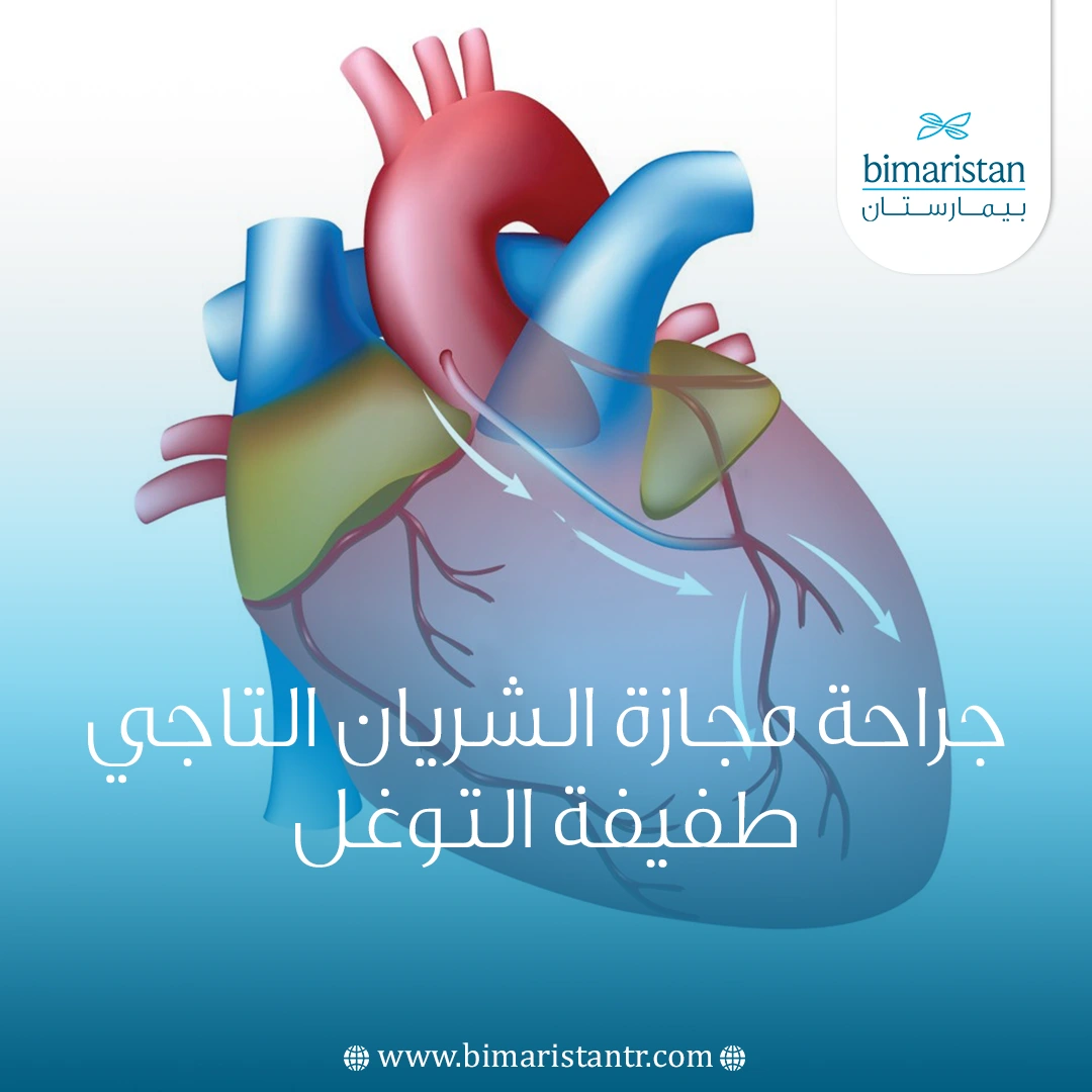 جراحة مجازة الشريان التاجي في تركيا