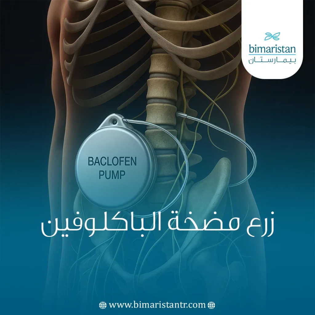 زرع مضخة الباكلوفين