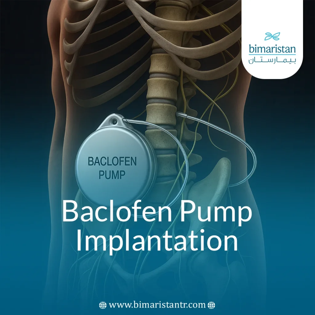 Baclofen Pump Implantation: Effective Treatment For Spasms
