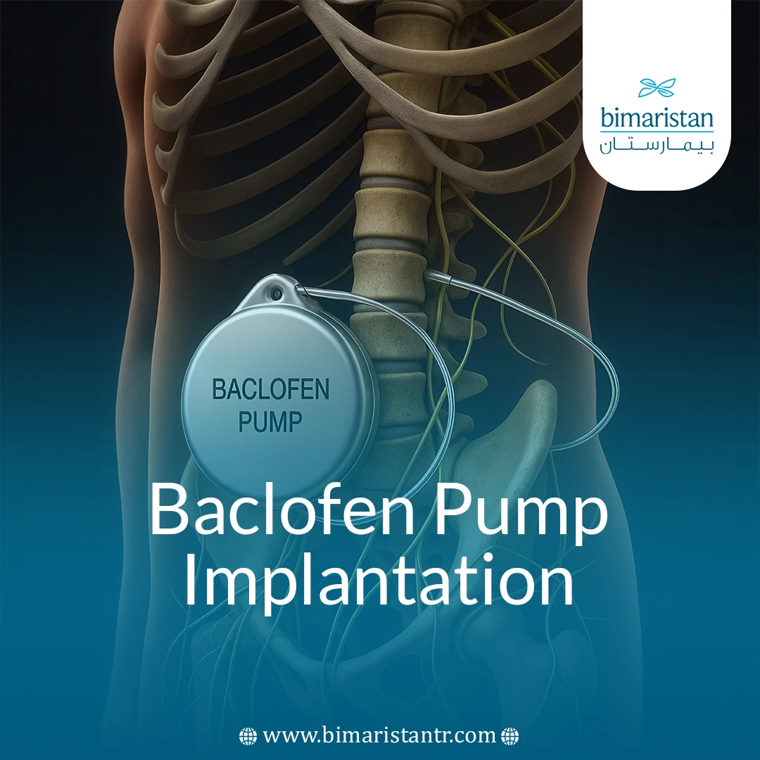 Baclofen Pump Implantation: Effective Treatment For Spasms