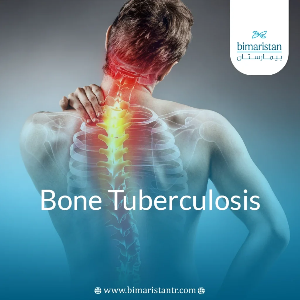 Bone Tuberculosis