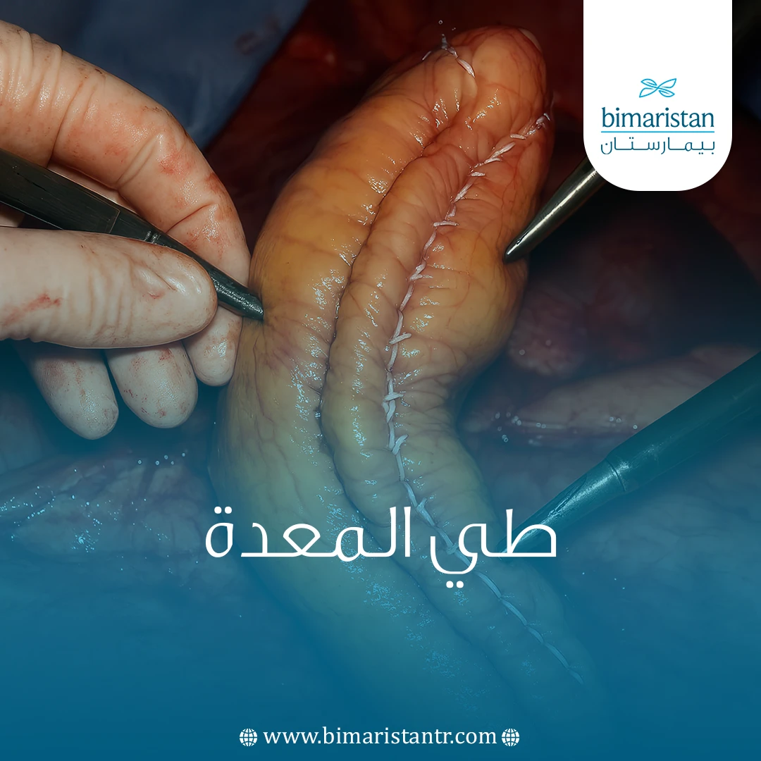 عملية طي المعدة