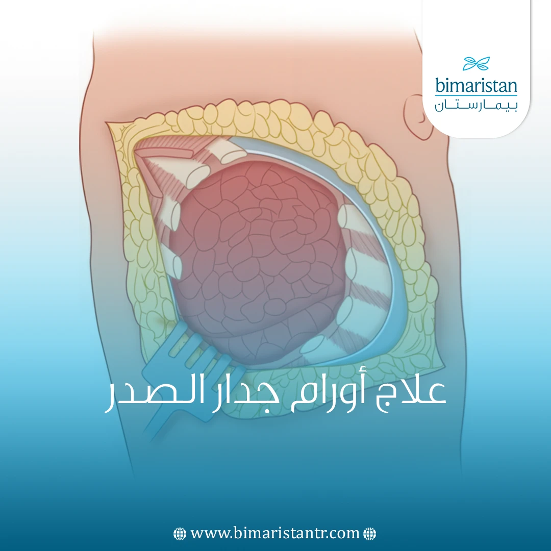 علاج أورام جدار الصدر