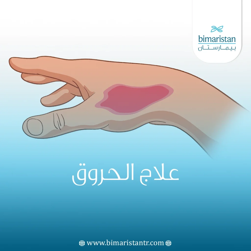 علاج الحروق في تركيا