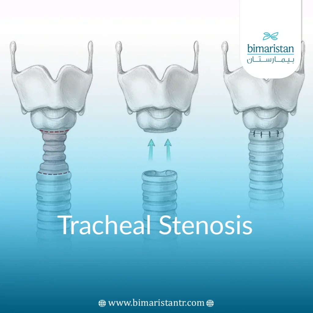 Tracheal Stenosis: Causes, Diagnosis &Amp; Treatment In Turkey