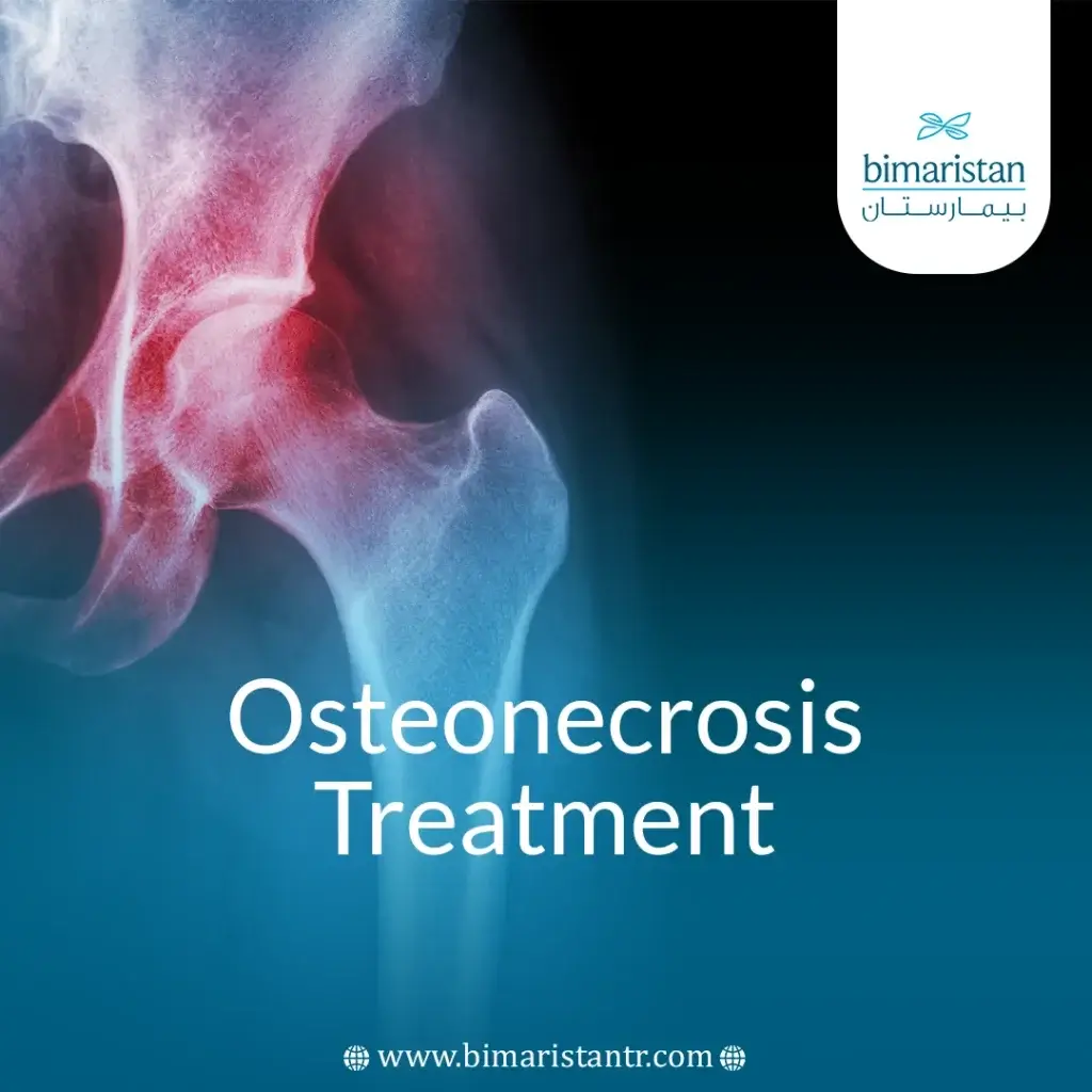 Osteonecrosis Treatment