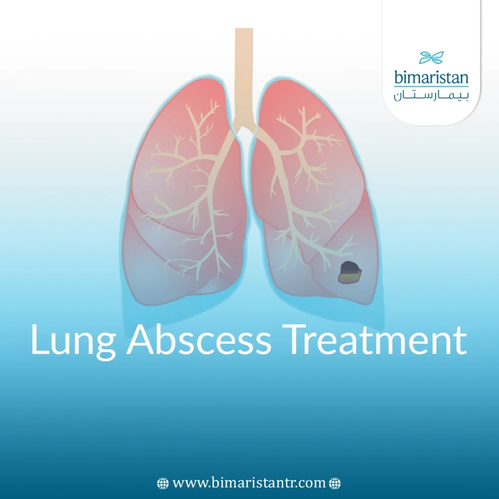 Lung Abscess Treatment: Removal &Amp; Prevention - Bimaristan
