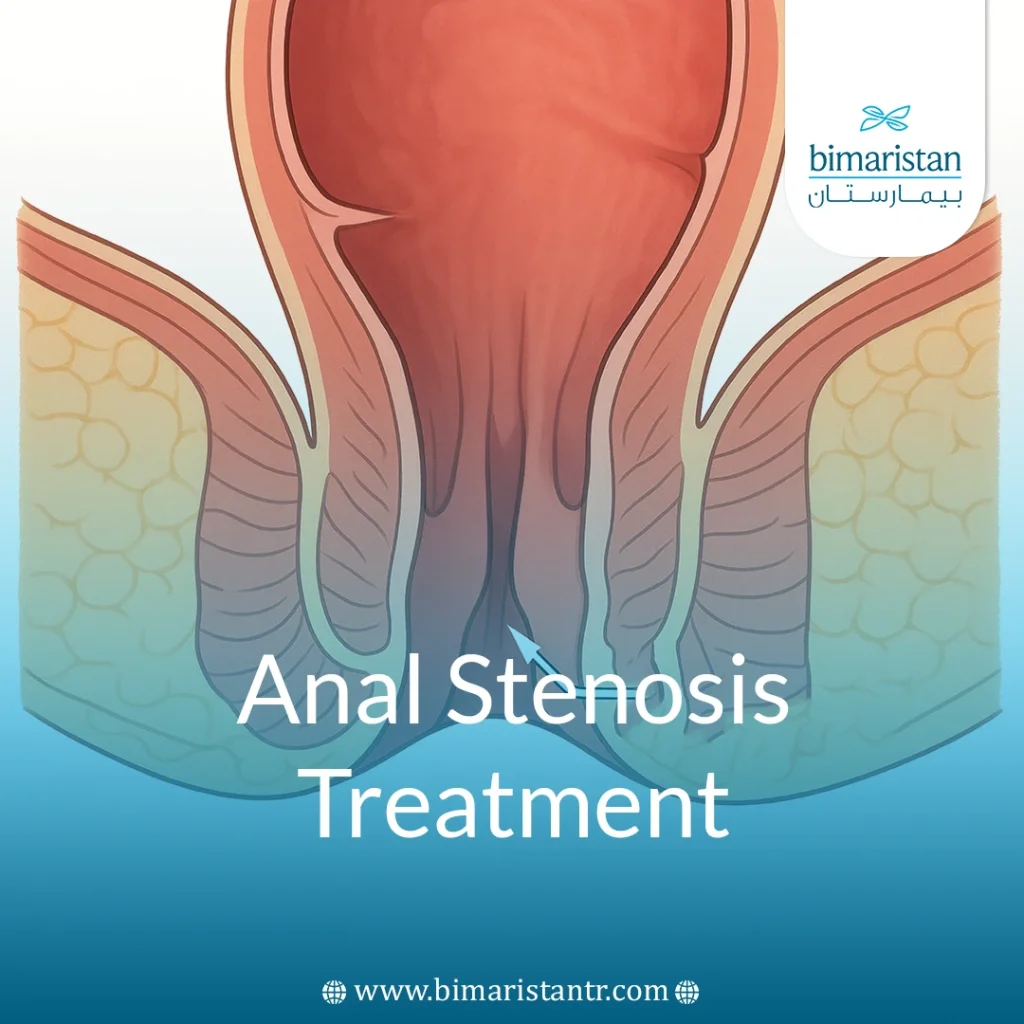 Anal Stenosis Treatment: Causes, Prevention &Amp; Tips