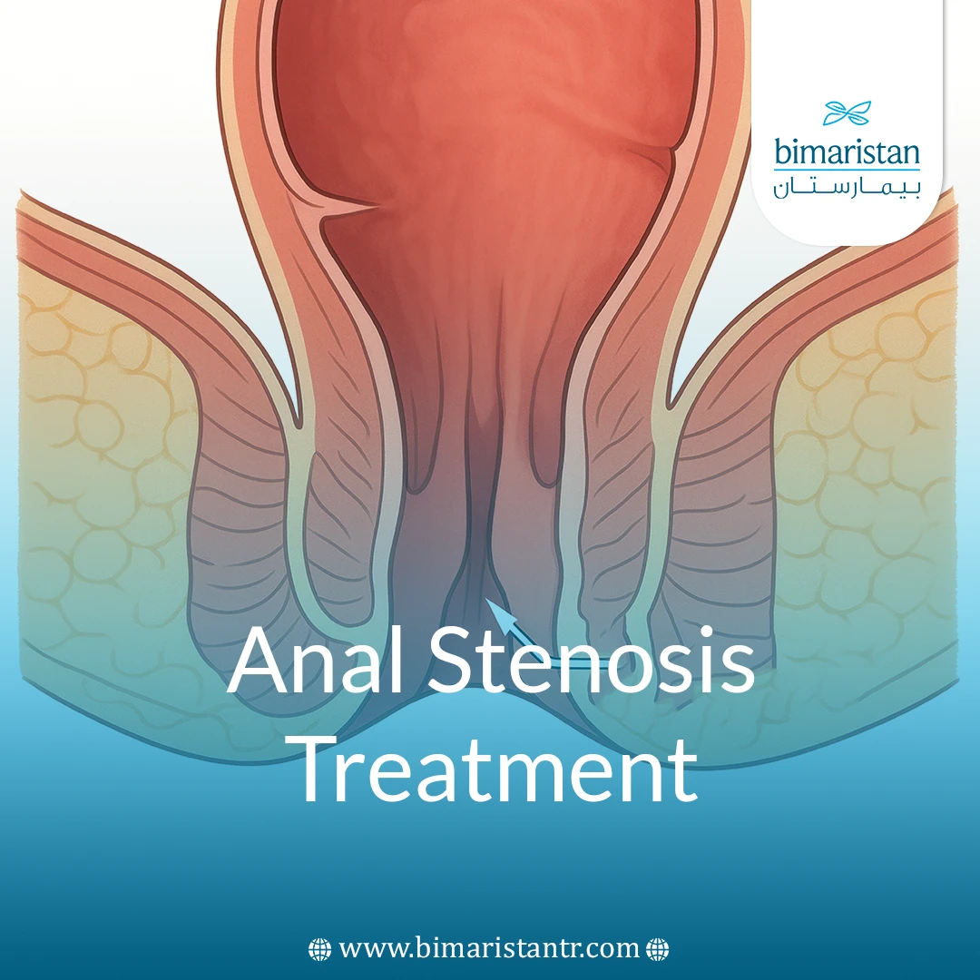 Anal Stenosis Treatment: Causes, Prevention &Amp;Amp; Tips