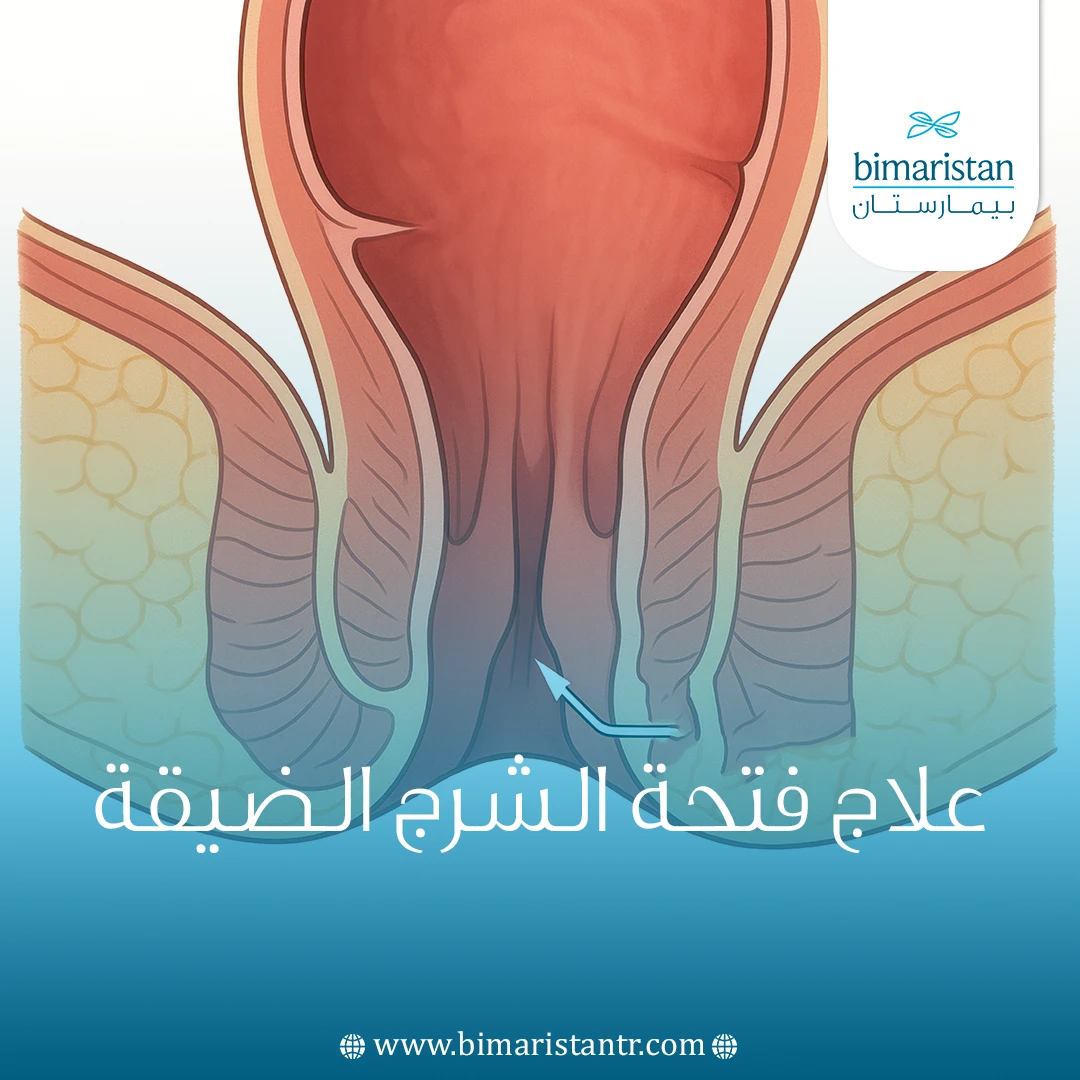 علاج فتحة الشرج الضيقة