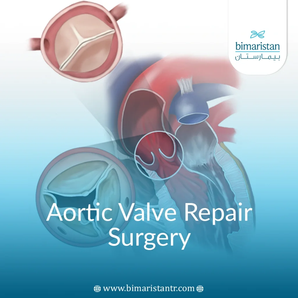 Aortic Valve Repair Surgery In Turkey - Bimaristan