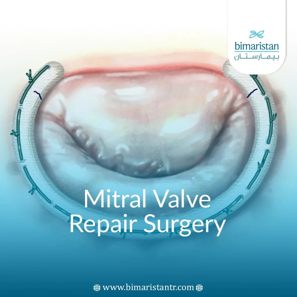Mitral Valve Repair Surgery In Turkey - Bimaristan