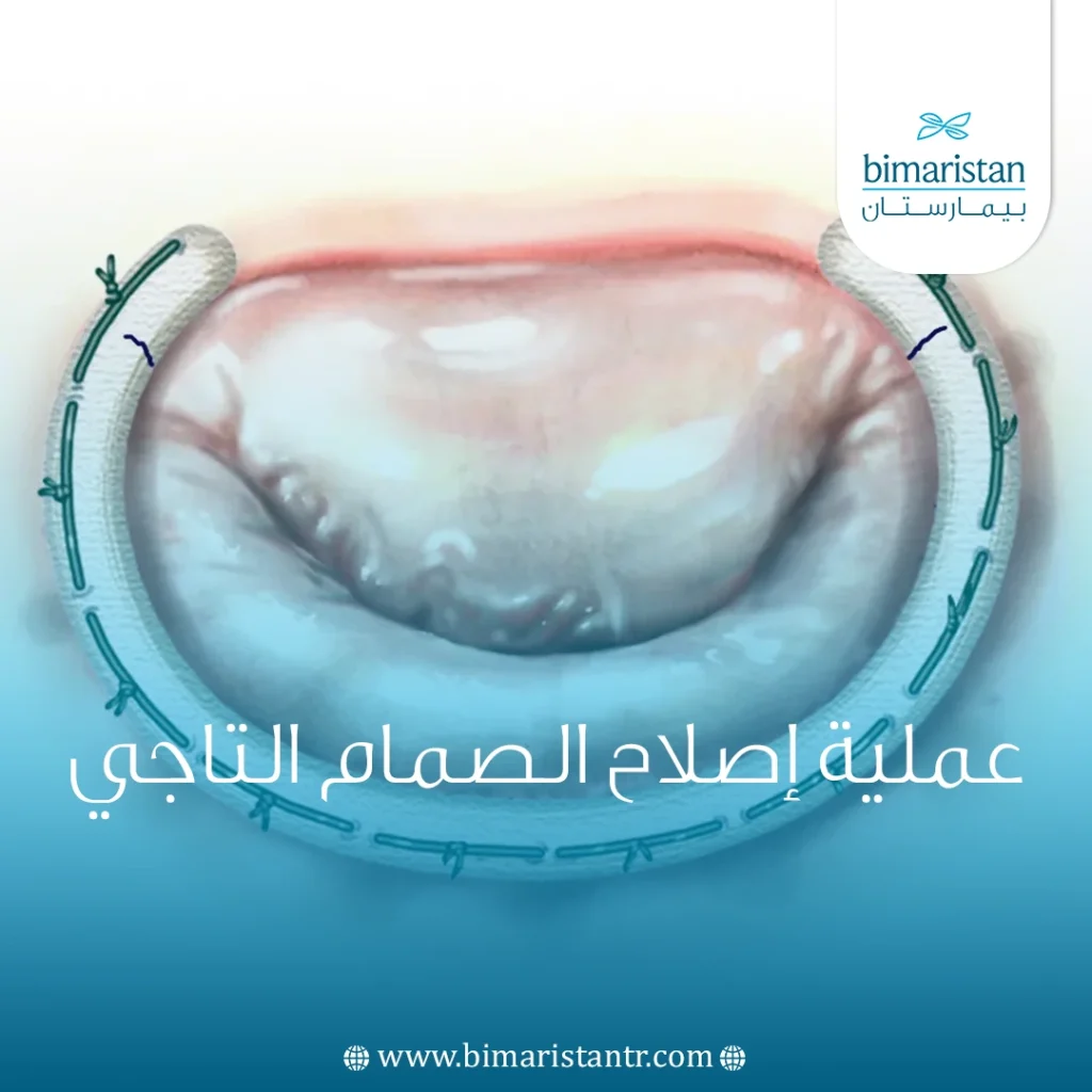 عملية إصلاح الصمام التاجي في تركيا