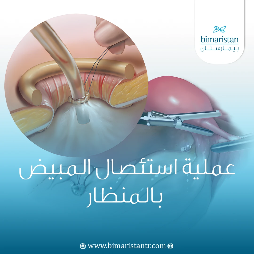 عملية استئصال المبيض بالمنظار