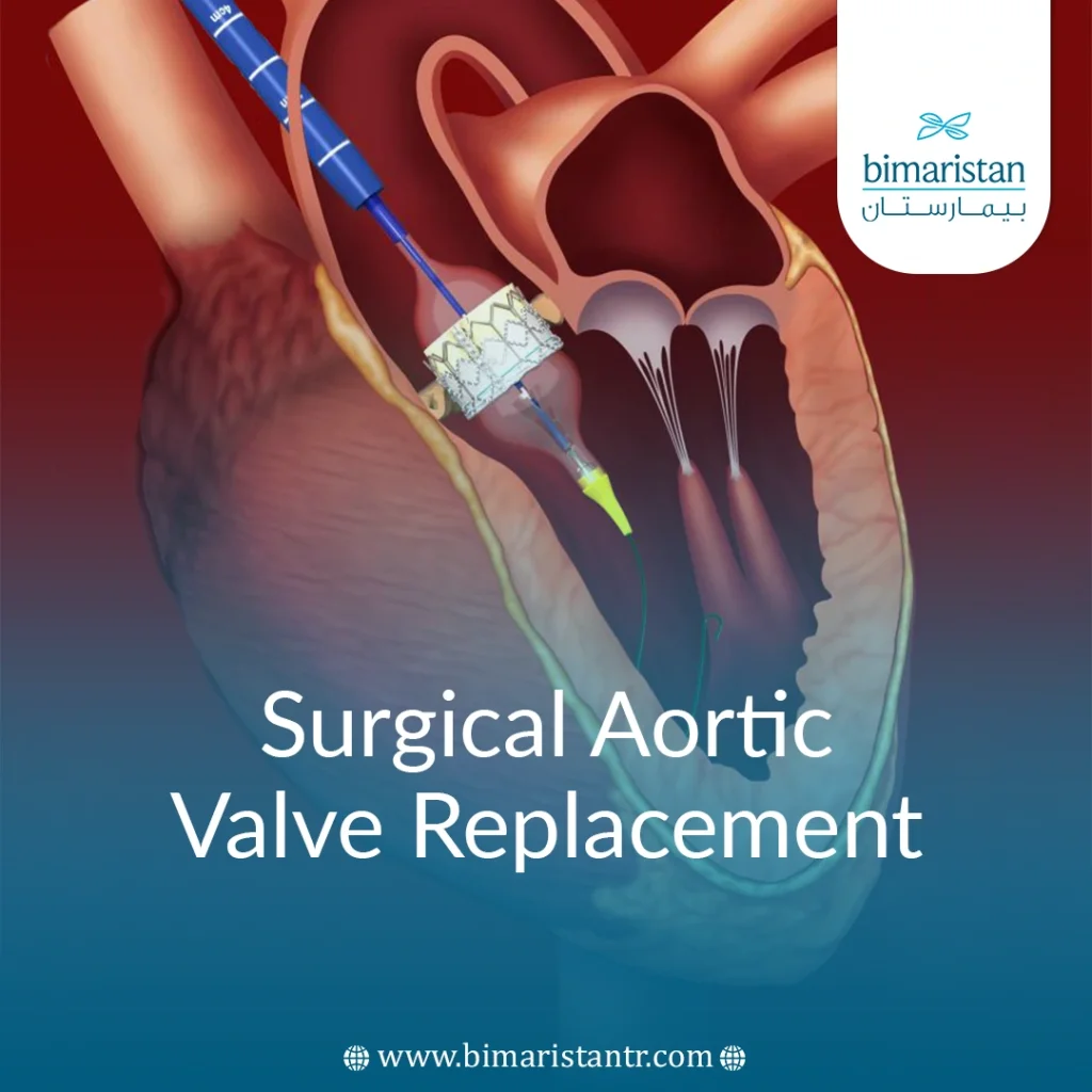 Surgical Aortic Valve Replacement In Turkey - Bimaristan