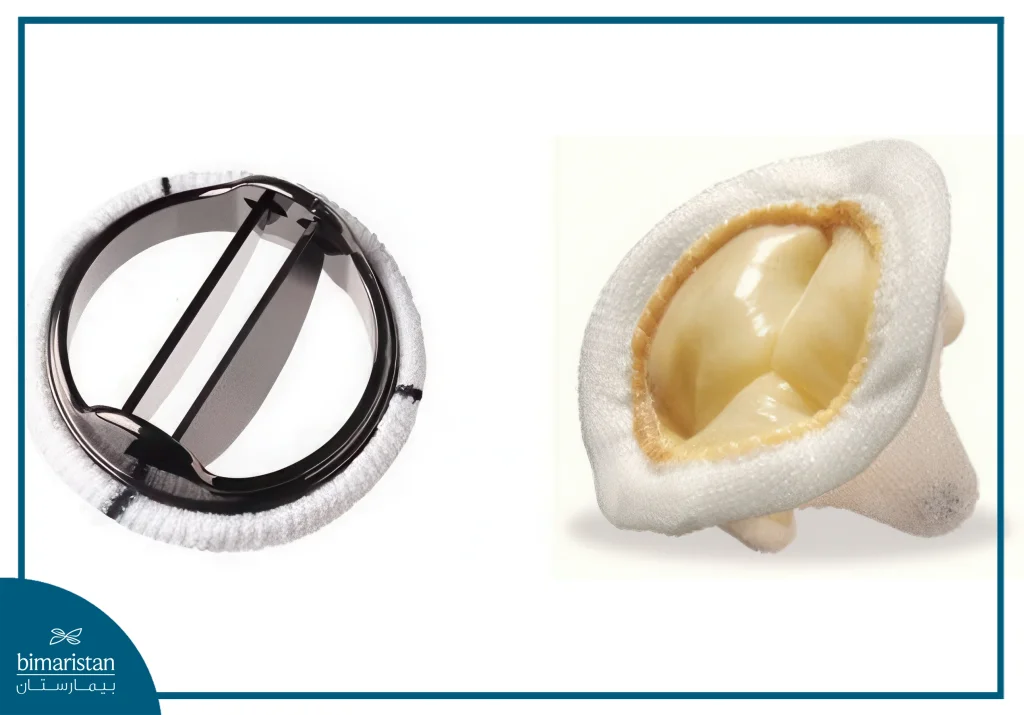 Surgical Aortic Valve Replacement in Turkey - Bimaristan