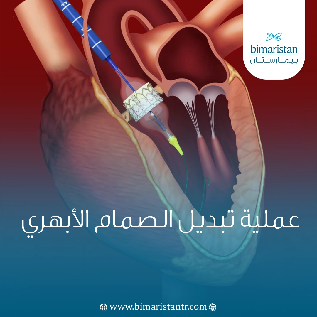 عملية تبديل الصمام الأبهري في تركيا