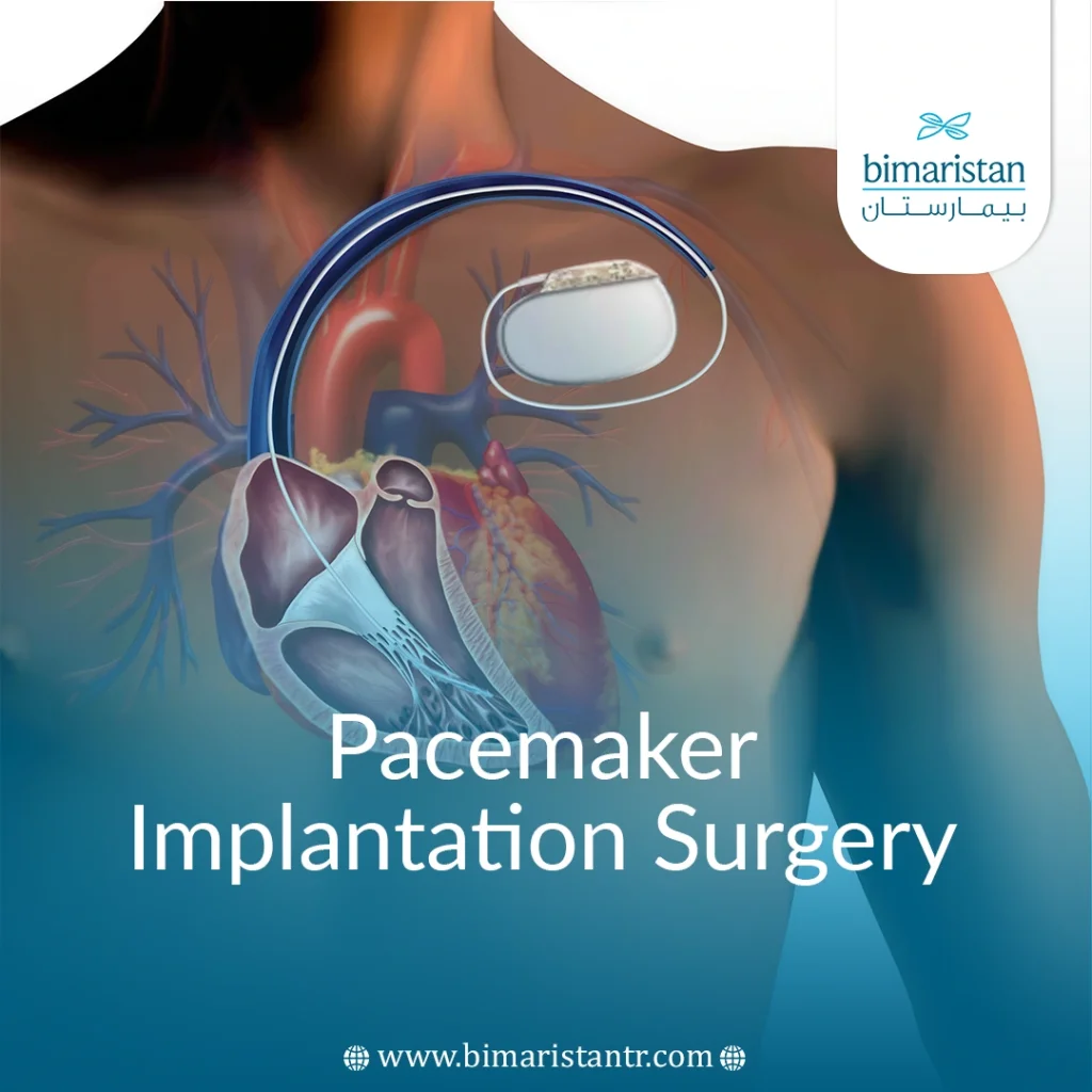 Pacemaker Implantation Surgery In Turkey - Bimaristan
