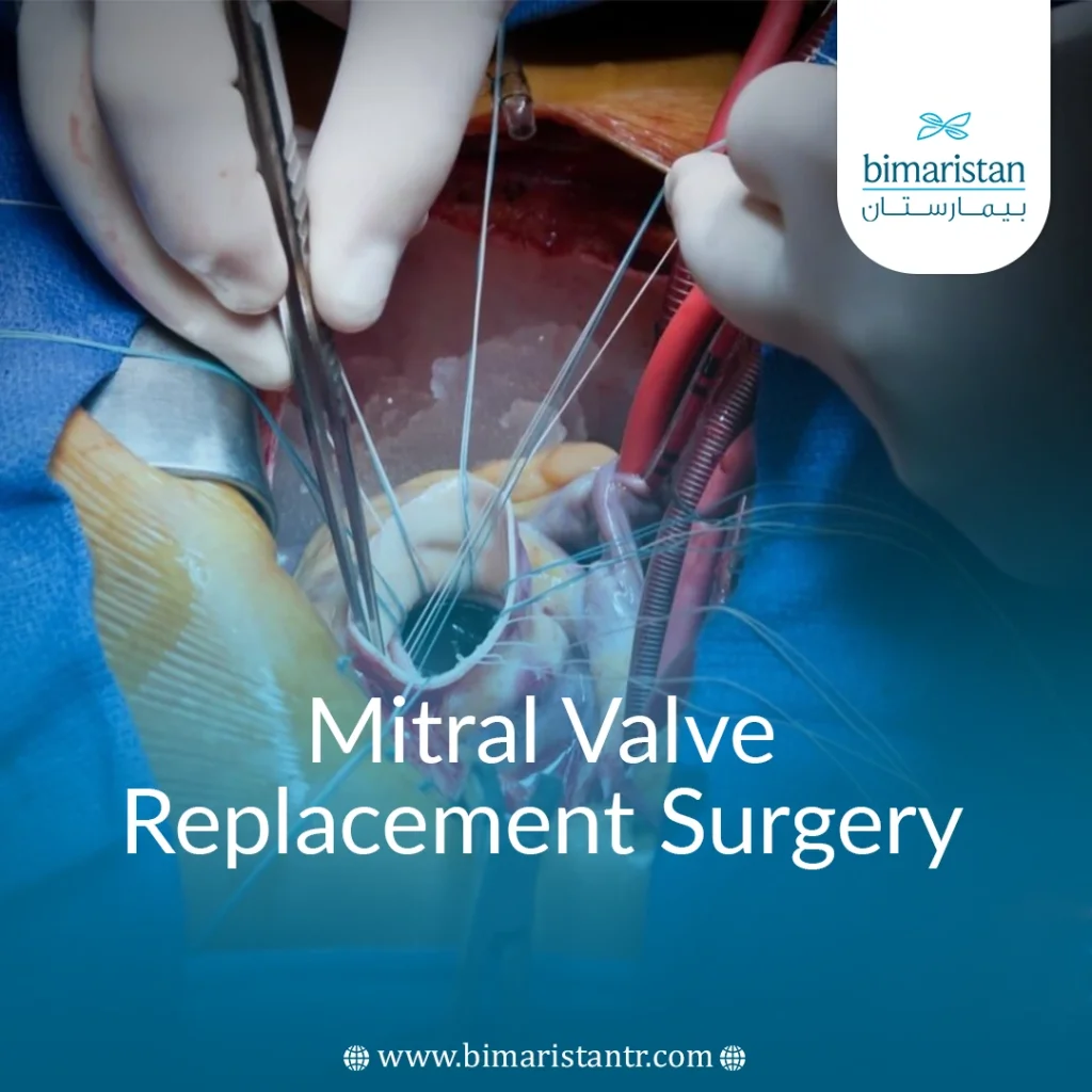 Mitral Valve Replacement Surgery In Turkey - Bimaristan