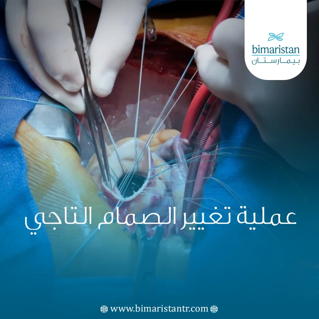 عملية تغيير الصمام التاجي في تركيا