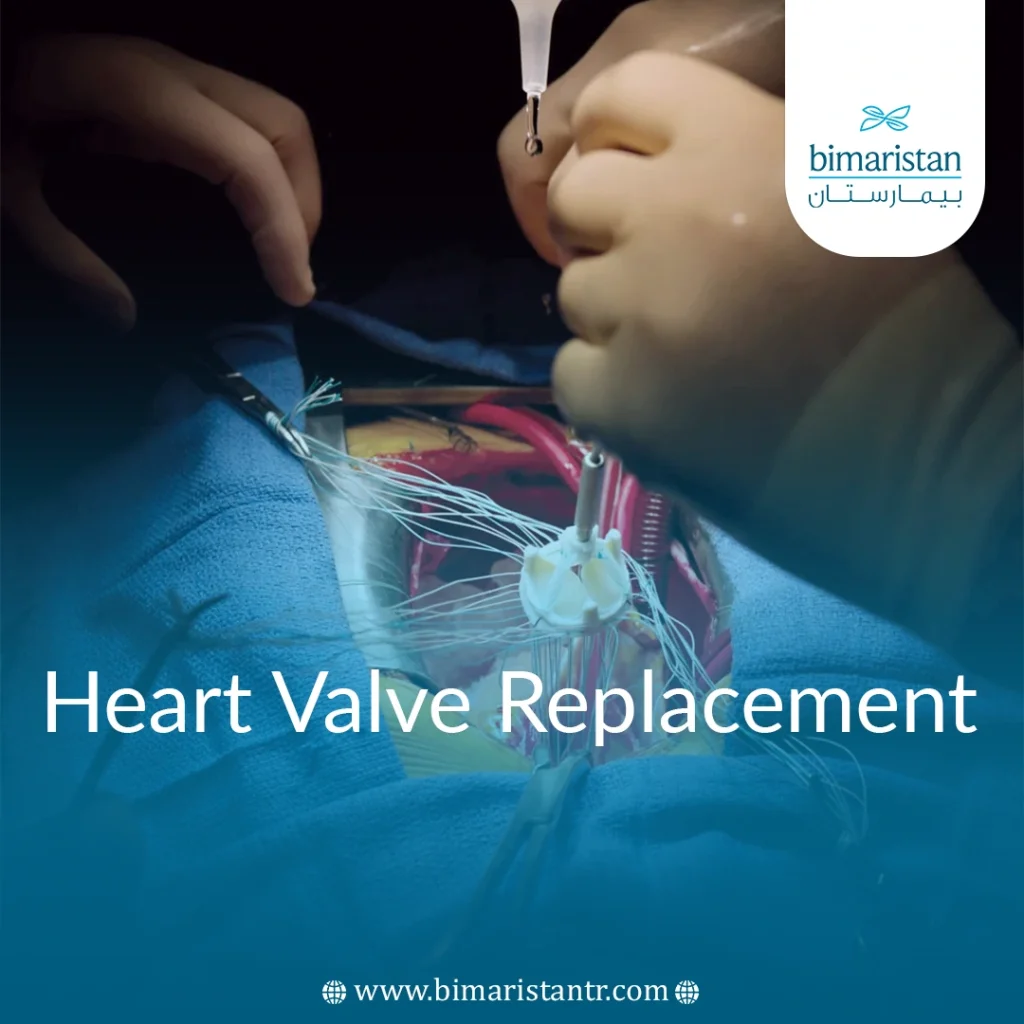 Heart Valve Replacement Surgery In Turkey - Bimaristan