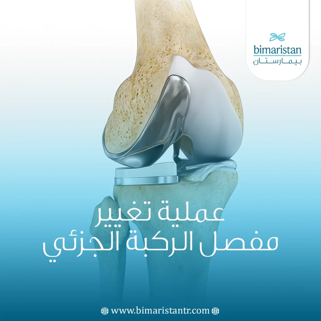 عملية تبديل مفصل الركبة الجزئي