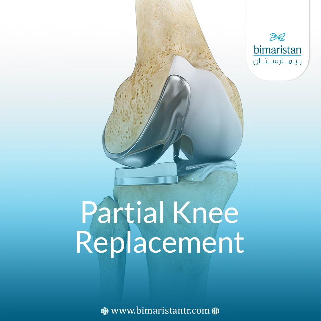 Partial Knee Replacement Surgery In Turkey - Bimaristan
