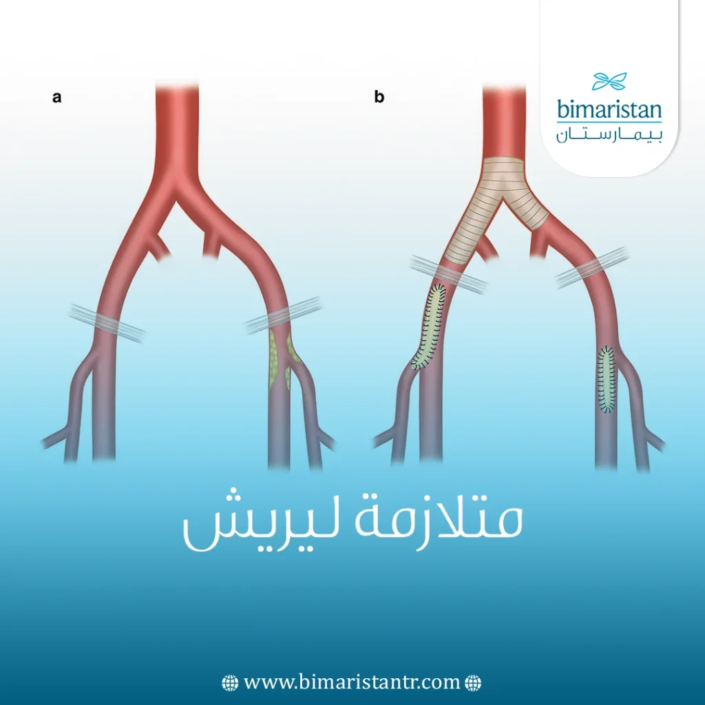 متلازمة ليريش - علاج انسداد أسفل الأبهر في تركيا