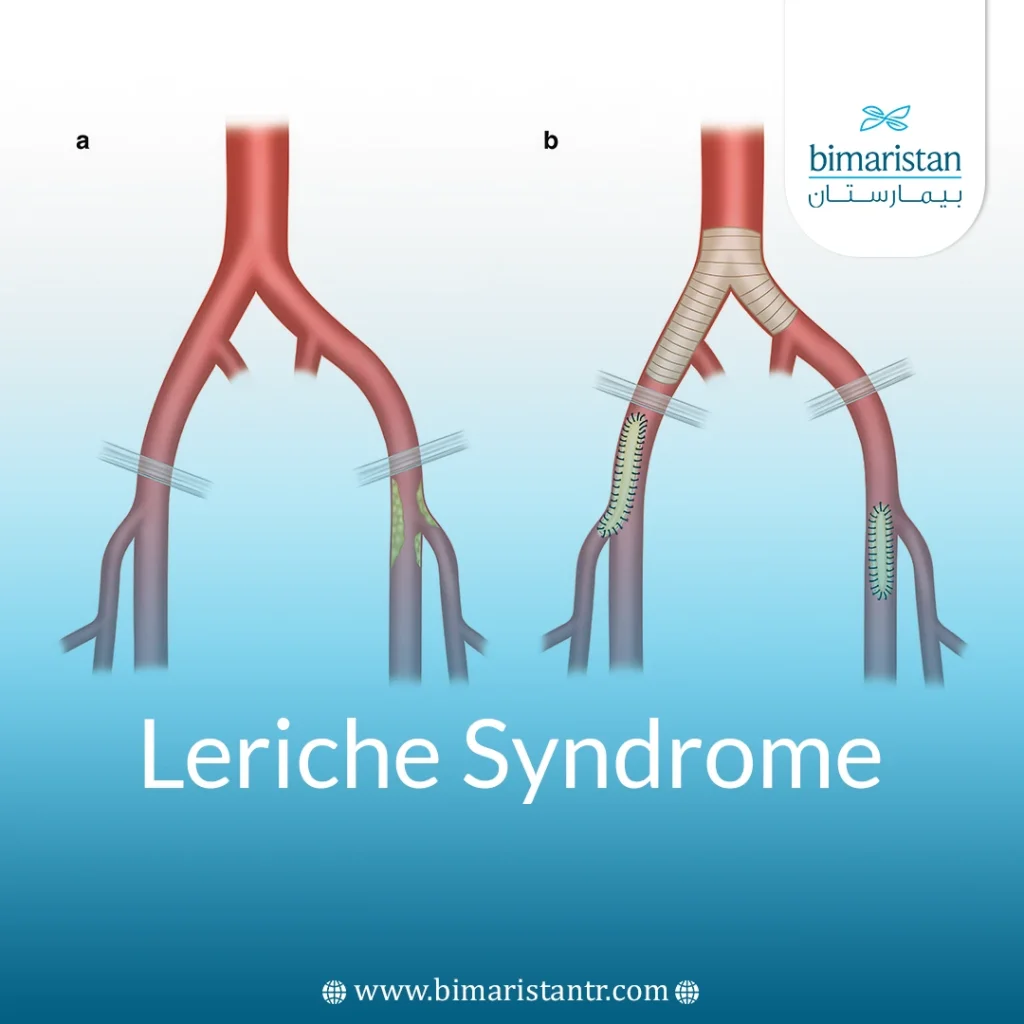 Leriche Syndrome - Lower Aortic Occlusion Treatment