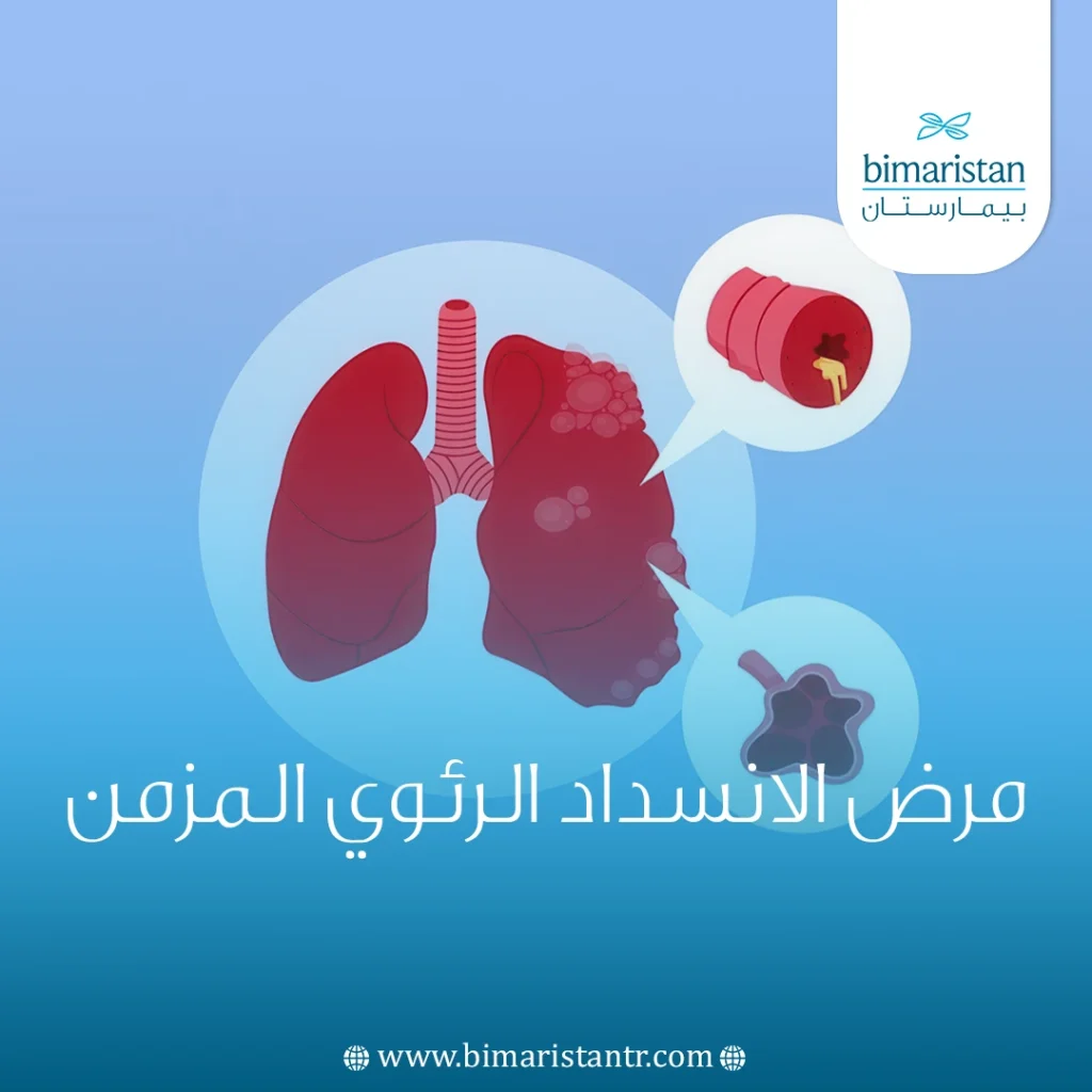 مرض الانسداد الرئوي المزمن