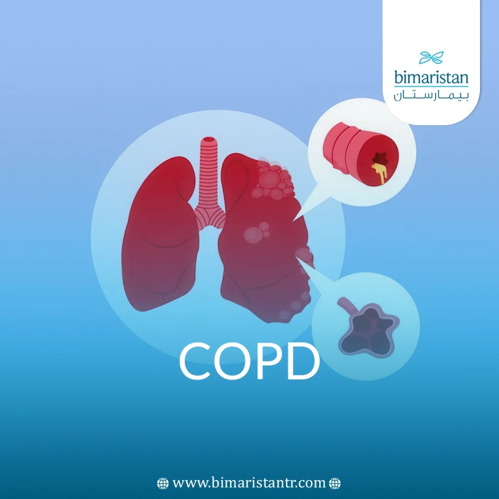 Chronic Obstructive Pulmonary Disease (Copd)