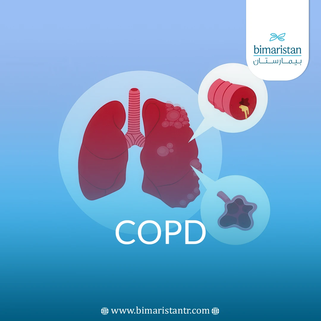 Chronic Obstructive Pulmonary Disease (Copd)