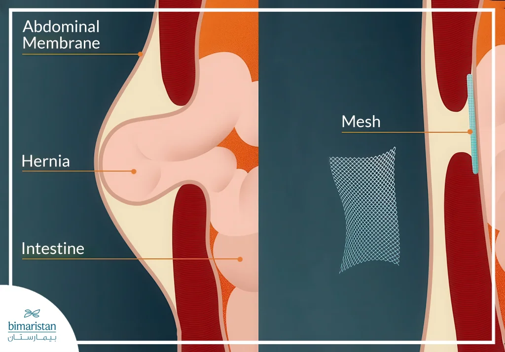 The Use Of Modern Medical Meshes Is One Of The Latest Umbilical Hernia Repair Techniques