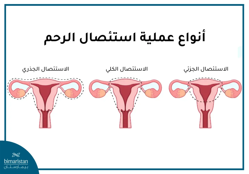 أسباب استئصال الرحم: متى يكون الخيار الجراحي ضرورياً؟ 2 أسباب استئصال الرحم: أنواع عملية استئصال الرحم