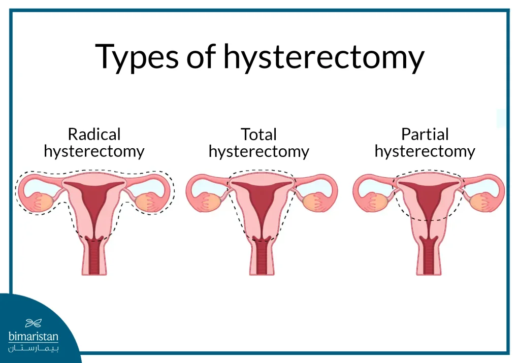 Reasons For Hysterectomy: Types Of Hysterectomy