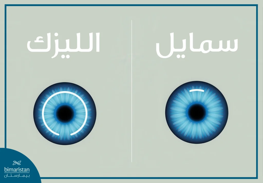 أفضل علاجات العيون: مقارنة بين تقنية السمايل والليزك من حيث طريقة إجراء الشق