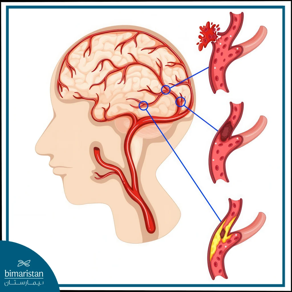 Cerebrovascular Diseases: Top Causes And Latest Treatment Options 3 Cerebrovascular Diseases