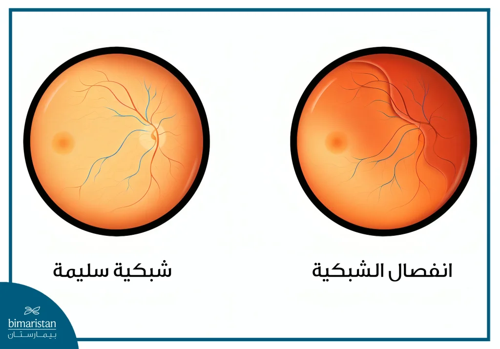 أمراض الشبكية: الأسباب، الأعراض، والعلاجات المتوفرة في تركيا 2 صورة توضح الفرق بين شبكية سليمة بتفاصيلها الطبيعية وأخرى منفصلة تنكمش وتبتعد عن جدار العين