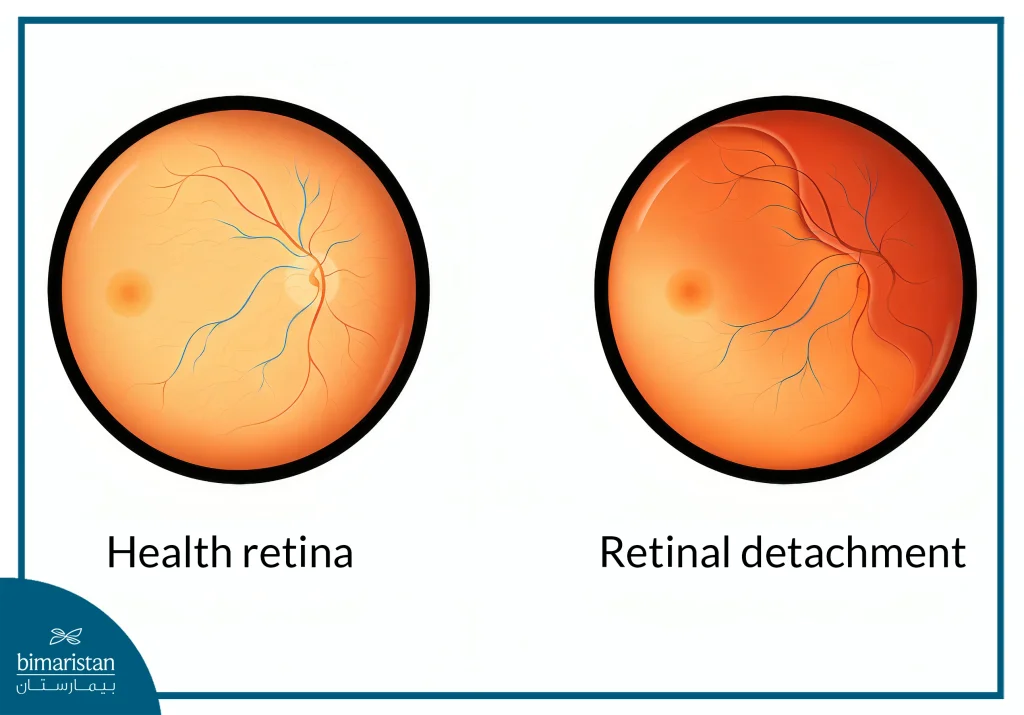 Retinal Diseases: Causes, Symptoms, And Treatment Options In Turkey 2 Image Showing A Healthy Retina Vs. A Detached Retina In Retinal Diseases, Where It Shrinks And Separates From The Eye Wall.