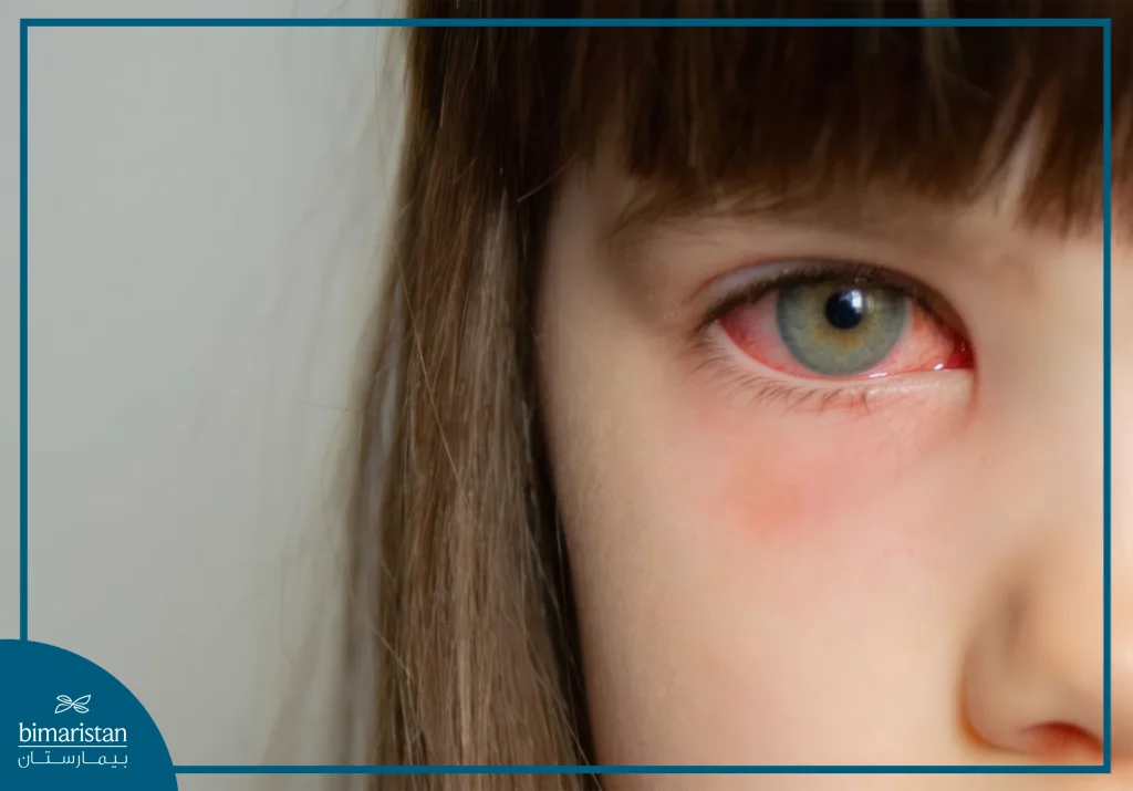 التهاب الملتحمة (العين الوردية)