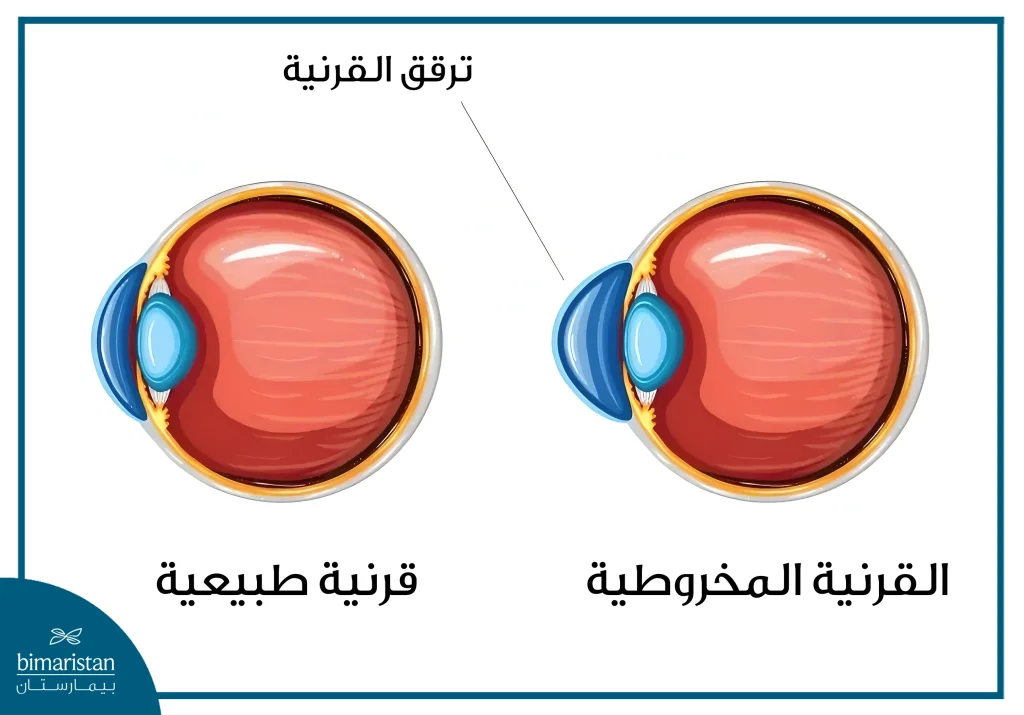 أمراض القرنية الشائعة وطرق العلاج والوقاية منها 2 القرنية المخروطية هي أحد أمراض القرنية التي يحدث فيها تغير في شكل القرنية