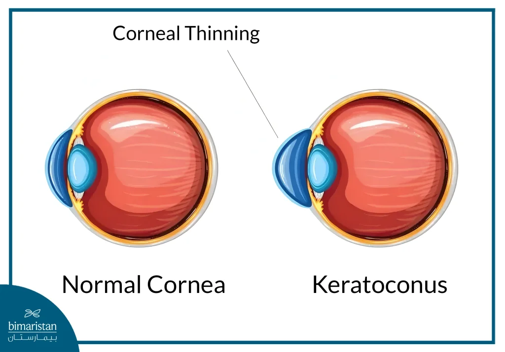 Keratoconus Is A Corneal Disease In Which There Is A Change In The Shape Of The Cornea