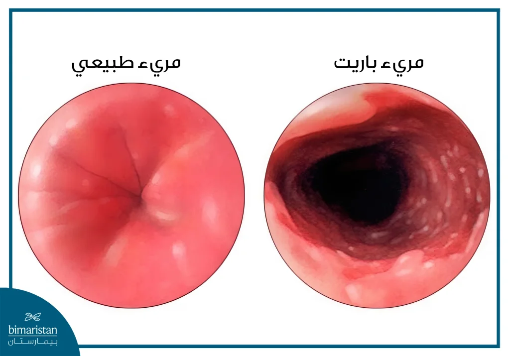 صورة توضح الفرق بين المريء الطبيعي ومريء باريت من حيث شكل ونسيج البطانة الداخلية