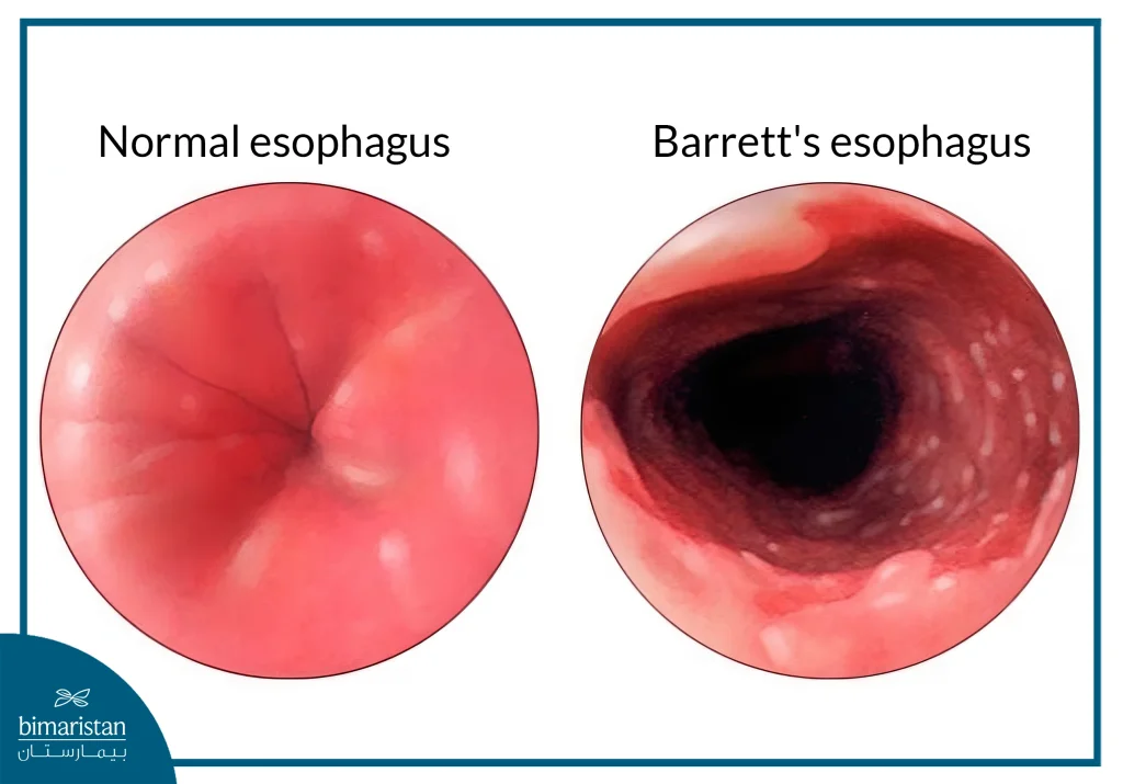Image Showing The Difference Between A Normal Esophagus And Barrett'S Esophagus In Terms Of The Shape And Texture Of The Inner Lining, As Seen In Esophageal Diseases.